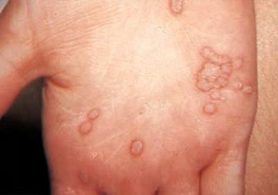 همه چیز درباره ی زگیل و انواع آن