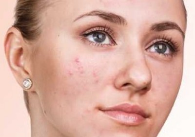 آکنه تان را با این ۱۰ روش بهبود دهید