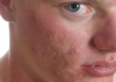 آشنایی با انواع آکنه های صورت