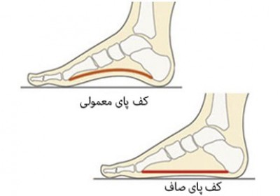 علت صافی کف پا چیست؟