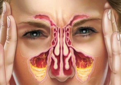 هرآنچه باید درباره ی سینوزیت  بدانیم