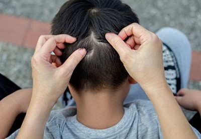 2 روش طبیعی ساده برای از بین بردن شپش سر