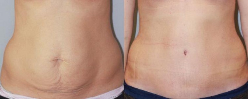 از شر چربی پایین شکم خلاص شویم