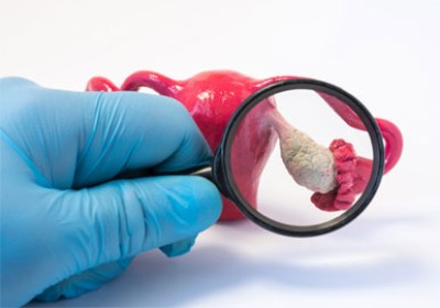 همه چیز درباره سندرم تخمدان پلی کیستیک (PCOS)