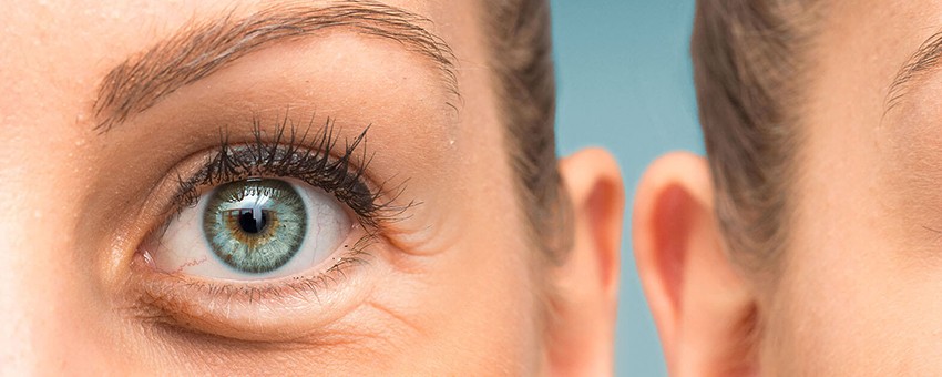 پف زیر چشم نتیجه کمبود کدام ویتامین است؟