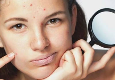 چگونه از شر قرمزی جوش و آکنه خلاص شویم؟